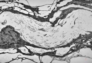 F,11y. | the wall of the arachnoid cyst F,11y. | the wall of the arachnoid cyst